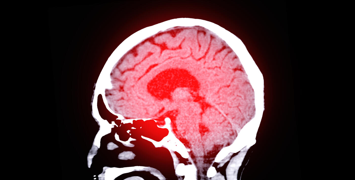 x-ray of brain injury